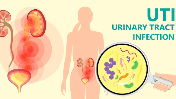 Urinary Tract Infection Treatment PACK image