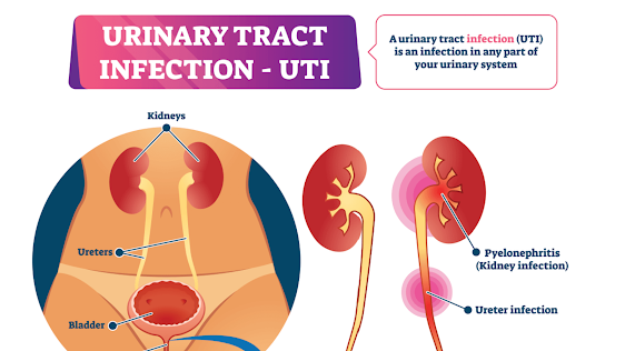 Urinary Tract Infection Treatment PACK image