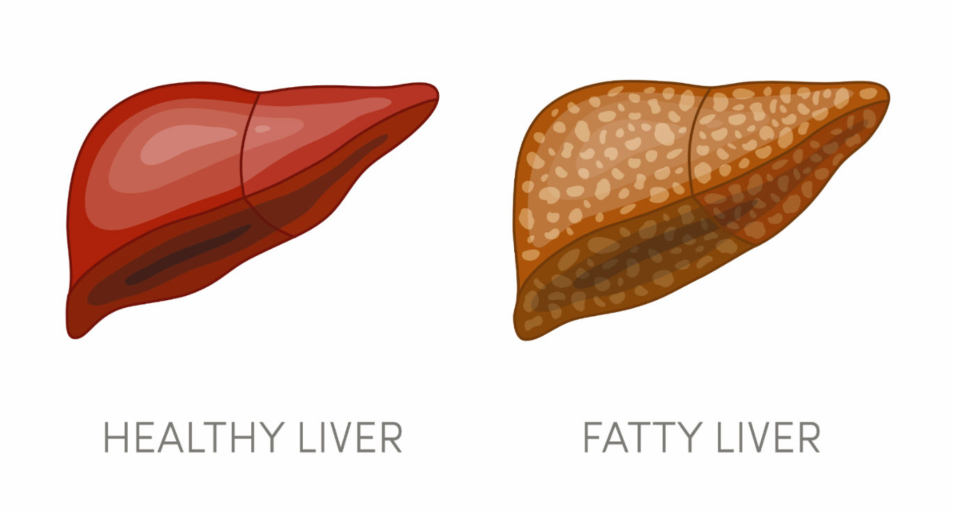 effective HEPATITIS B OR C FATTY LIVER TREATMENT IN GHANA image